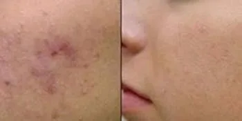 MEBO Original Scars and Burn Fast and Perfect Results (15 Gram) - Scar Removal