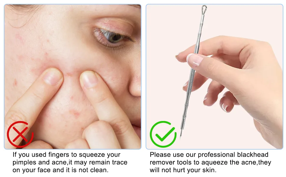 Extractor Acne Tools Stainless Steel Beauty Blackhead Comedone Removal 2-in-1 Pimple Popper Tool for Face Nose (2 Pack) 2 pack silver - TOOLS