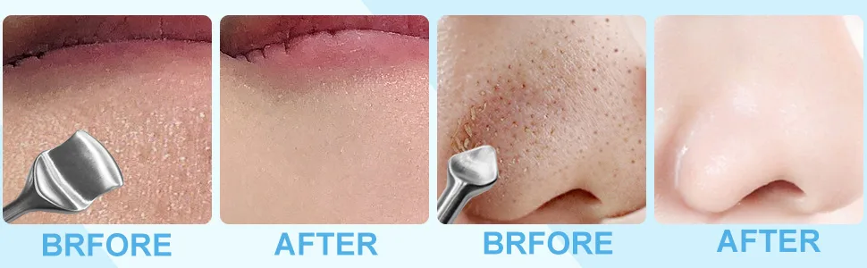Facial Pore Cleaner Scraper with Extractor Tools 2 Pack Stainless Steel Double-Head Blackhead Remover Sticks for Acne Comedone Blackhead Face Cleaning Shovel Makeup Accessories 2 pack silver - blackhead tools