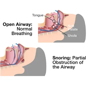 SleepRight Intra-Nasal Breathe Aids Breathing Aids for Sleep Nasal Dilator - 2 Pack (4 Pieces) - why we snore, sleep right