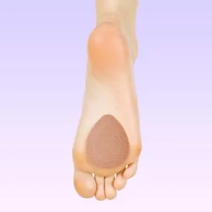 PrimeMed Self-Adhesive Skived Dancer Pads - (1/8 Thick Tan Felt) Metatarsal Pads (4 Pack) - metatarsal pad on foot