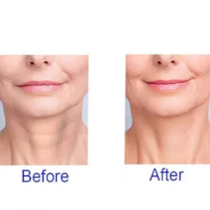 PHCOMRICH 2 Pack Neck Wrinkle Patch obvious results after multiple uses - Anti-aging Advanced skin firming Treatment and Prevention - Reusable Wrinkle Patch - Neck - Reusable Anti Wrinkle Patches Set 100% Medical Grade Face Silicone 5 Pads Reduce Smooth Wrinkles