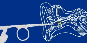 Bionix - Lighted Articulating Ear Curette Earwax Removal Tool Helps Remove Excess Wax & Foreign Objects Convenient Easy to Use Ideal for Healthcare Professionals (25 Count) - Curettage