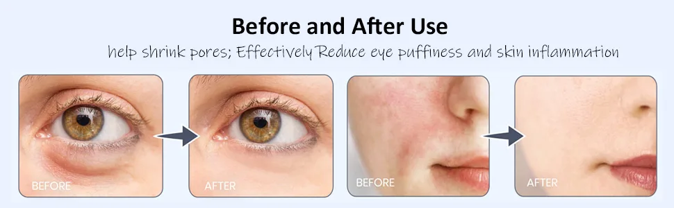 Ice Roller for Face and Eyes - Ice Roller & Small Ice Roller with Case - Before and After Use