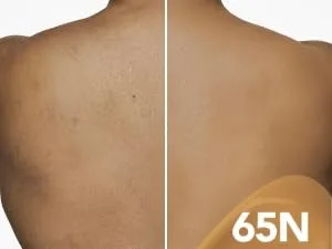 Dermablend Dermablend Leg and Body Makeup Foundation - HYPERPIGMENTATION