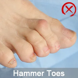 Sumiwish Gel Toe Separators 10 PCS Bunion Corrector Toe Straightener for Overlapping Toe Big Toe Spacer Great for Bunion Pain Relief White - not for hammer toes
