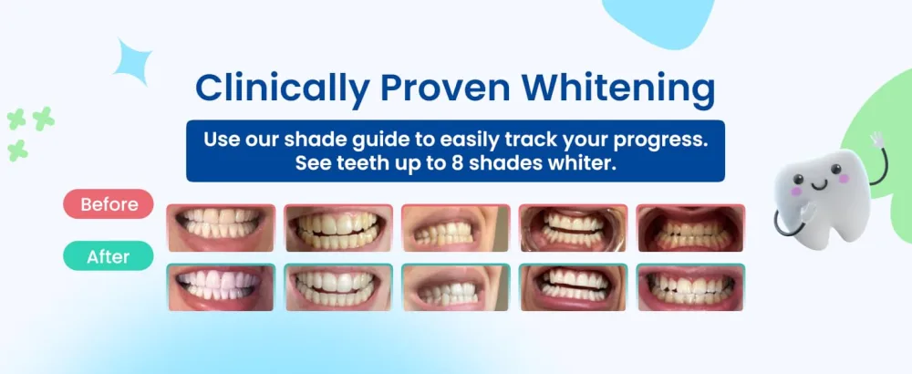 DrDent Premium Teeth Whitening Strips - 20 Sessions Non-Sensitive Formula 40 Peroxide Free Safe for Enamel + Mouth Opener Included - Clinically proven whitening.