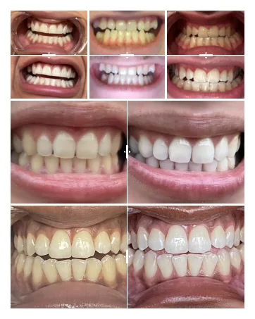 DrDent Premium Teeth Whitening Strips - 20 Sessions Non-Sensitive Formula 40 Peroxide Free Safe for Enamel + Mouth Opener Included - Modul 2