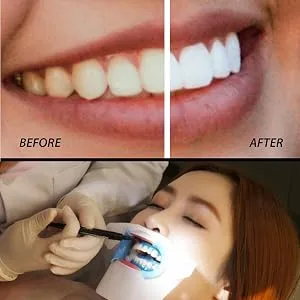 Gingival Protection Gel CARESHINE 10pcs 3ml Gum Protector Gel Gum Dam Barrier Gum Protection Gel Syringe Tip Teeth Whitening Decrease Sensitivity - Gingival Protection Gel