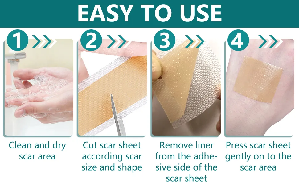Silicone Scar Sheets Professional for Scars Caused by C-Section Surgery Burn Keloid Acne and More Drug-Free Silicone Scar Roll 3Meters  - product information 2