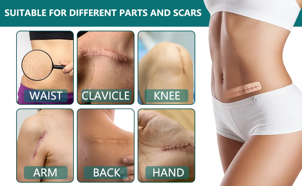 Silicone Scar Sheets Professional for Scars Caused by C-Section Surgery Burn Keloid Acne and More Drug-Free Silicone Scar Roll 3Meters  - product information 3