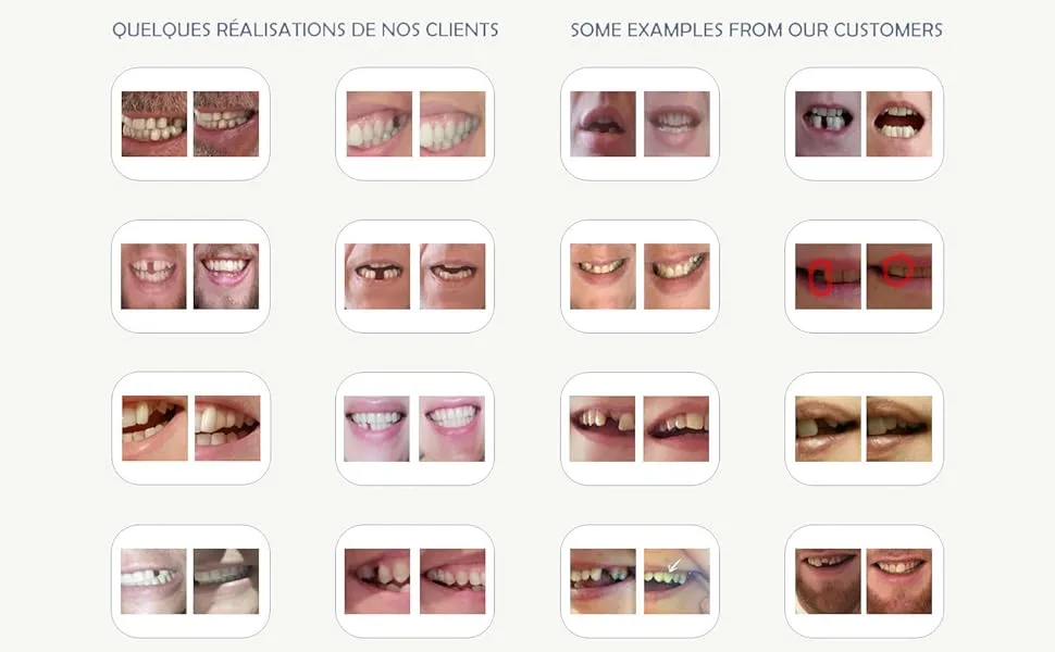 CREADENT Kit for Replacing a Missing Tooth with a Temporary Cosmetic Tooth - AVIS