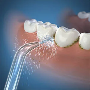 2Pcs Replacement Classic Jet Tips for Flosser WP100 WP250 WP300 WP450 WP660 WP900Other Oral Irrigators(Blue) - product information 4