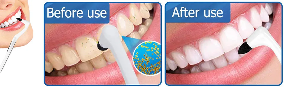 Dental Tartar Remover for Teeth Teeth Polishing Tooth Stain Clean Teeth Whitening(White) - product information 4