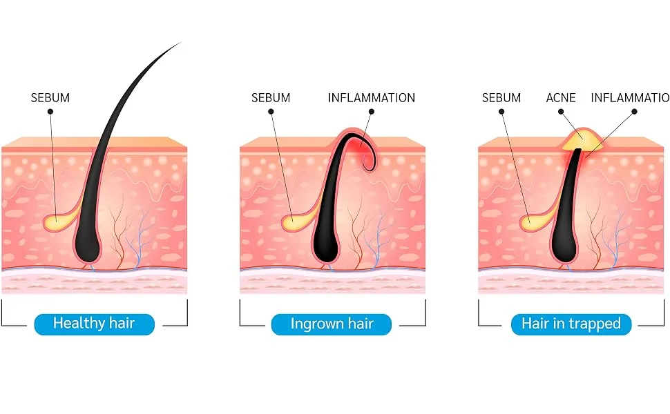 Ingrofix by BioClear - Ingrown Hair Treatment Perfect for Legs Hands & Face - Chin Cheeks Upper Lips Bikini Line Underarms Neck Chest Stomach | 110ml - Ingrown Hair