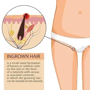 Ingrofix by BioClear - Ingrown Hair Treatment Perfect for Legs Hands & Face - Chin Cheeks Upper Lips Bikini Line Underarms Neck Chest Stomach | 110ml - Ingrown Hair