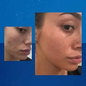 Differin Acne Treatment Gel - 45 Gram - Differin Gel